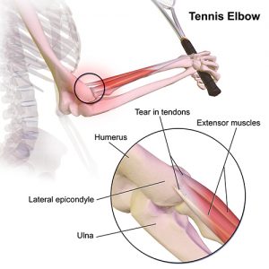 Lateral and Medial Elbow Epicondylitis
