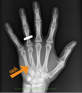 A 4th metacarpal spiral fracture