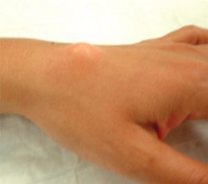 Ganglion Cysts