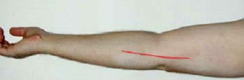 Cubital Tunnel Syndrome