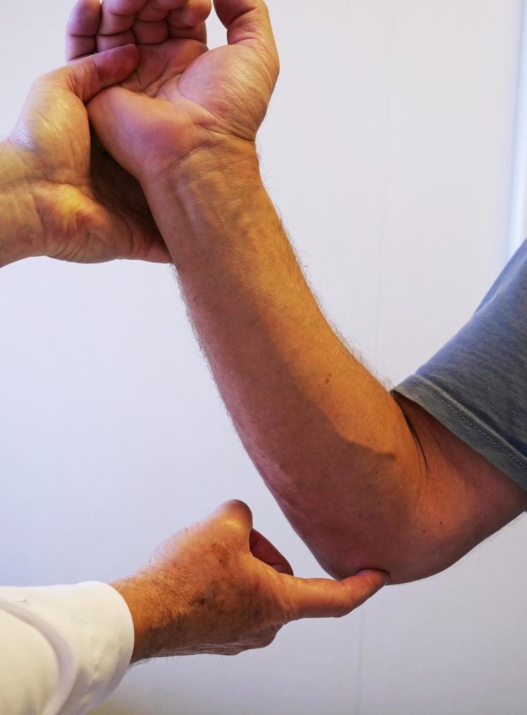 Cubital Tunnel Syndrome