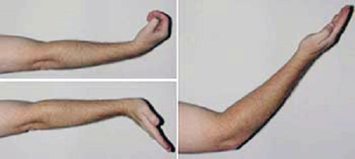 Cubital Tunnel Syndrome