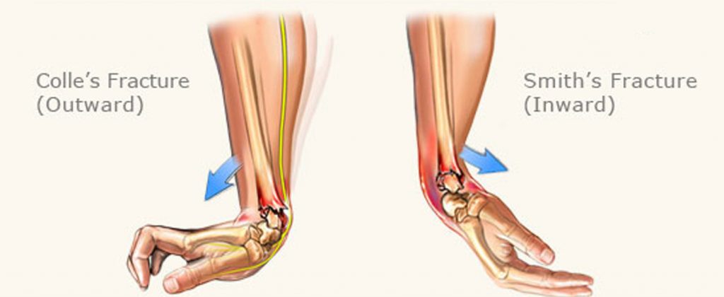 radial smith fracture with reduction cpt code