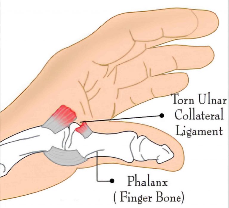 Thumb Ulnar Collateral Ligament (UCL) Injury - Tanya Coats OT